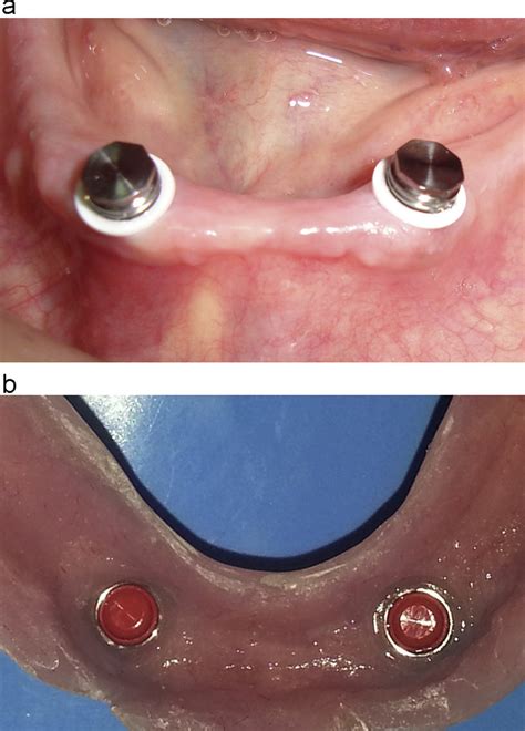 what is the metal housing denture|non allergic to metal dentures.